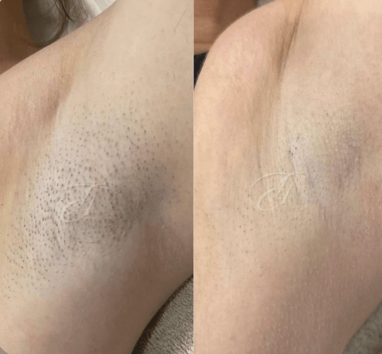 Resultaat laserontharing: minder irritatie
